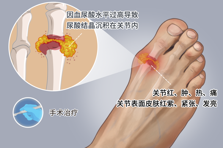  尿酸高别吃4类食物